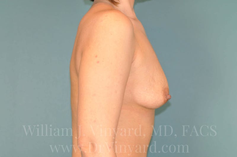 Breast Augmentation Before & After Gallery - Patient 171447882 - Image 5