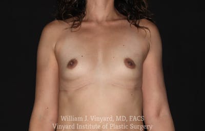 Breast Augmentation Before & After Gallery - Patient 171447895 - Image 1
