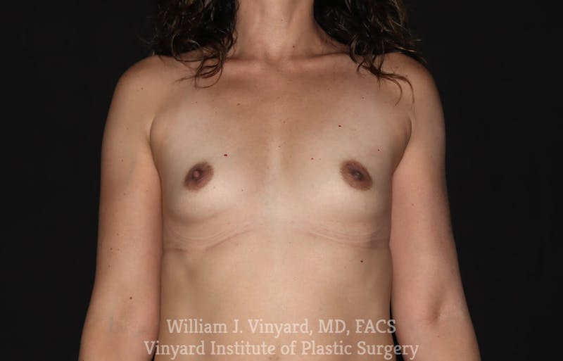 Breast Augmentation Before & After Gallery - Patient 171447895 - Image 1