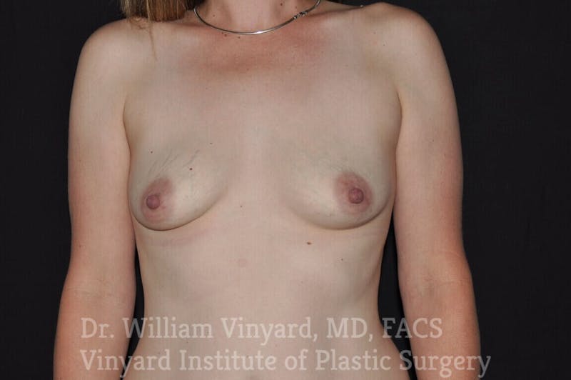 Breast Augmentation Before & After Gallery - Patient 171447944 - Image 1