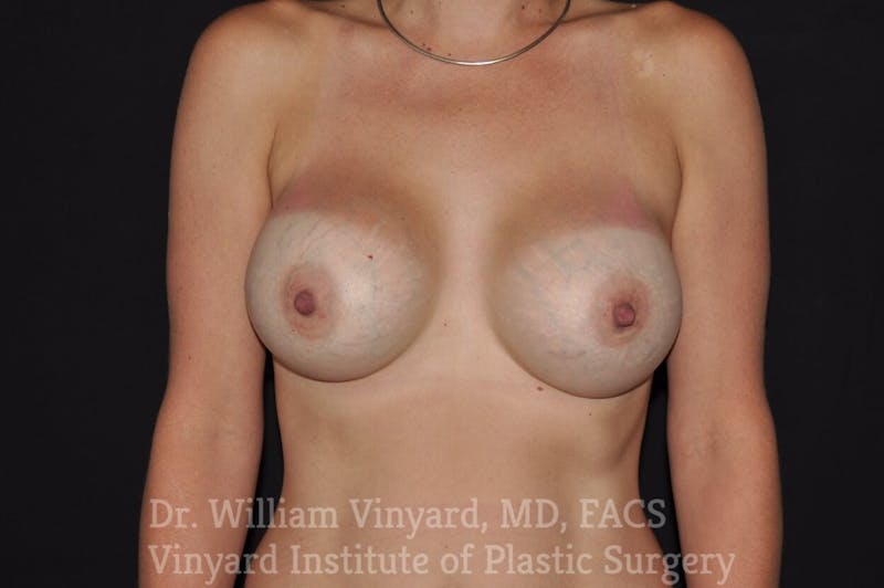 Breast Augmentation Before & After Gallery - Patient 171447944 - Image 2