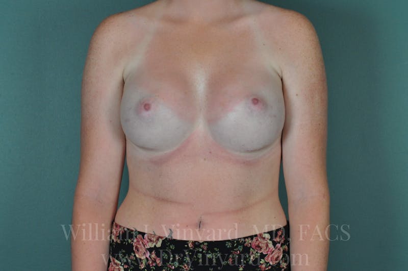 Breast Augmentation Before & After Gallery - Patient 171448407 - Image 4