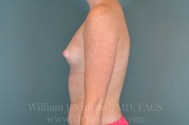 Breast Augmentation Before & After Gallery - Patient 171448407 - Image 9