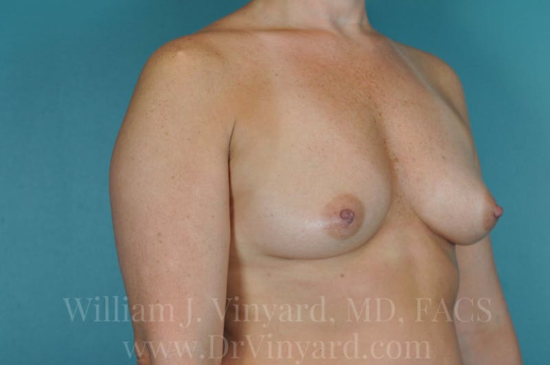 Breast Augmentation Before & After Gallery - Patient 171448942 - Image 1