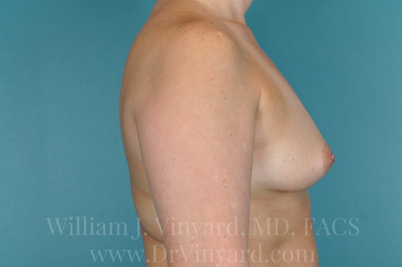 Breast Augmentation Before & After Gallery - Patient 171448942 - Image 5