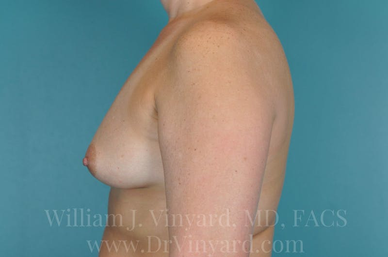 Breast Augmentation Before & After Gallery - Patient 171448942 - Image 9