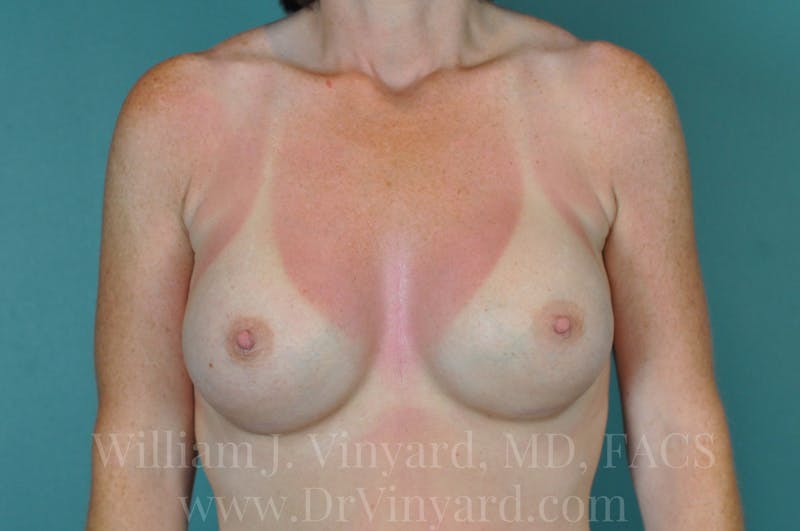 Breast Augmentation Before & After Gallery - Patient 171449438 - Image 4
