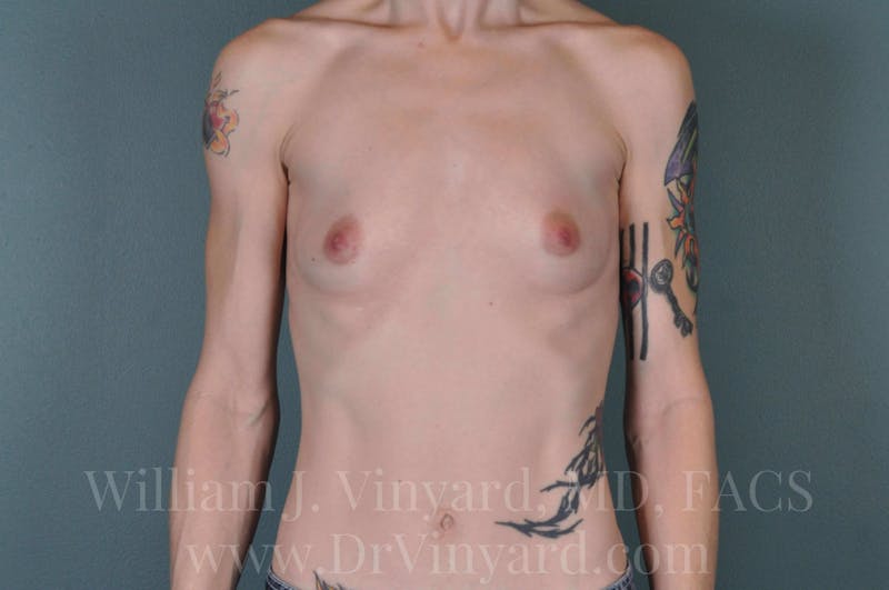 Breast Augmentation Before & After Gallery - Patient 171449458 - Image 3