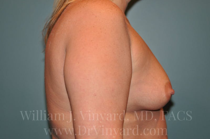 Breast Augmentation Before & After Gallery - Patient 171449464 - Image 5