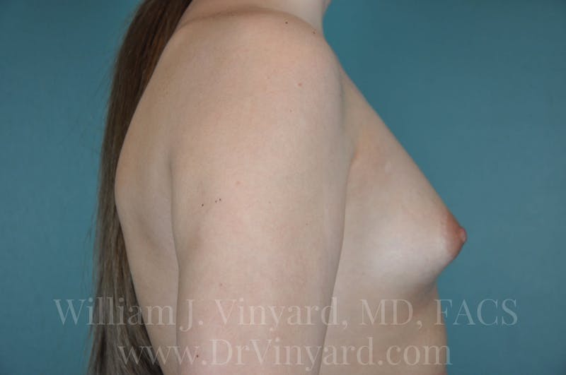 Breast Augmentation Before & After Gallery - Patient 171449483 - Image 5