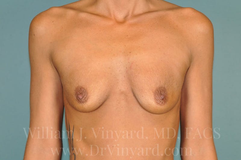 Breast Augmentation Before & After Gallery - Patient 171449981 - Image 3