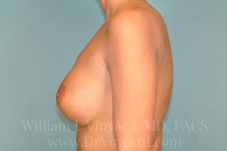 Breast Augmentation Before & After Gallery - Patient 171449981 - Image 10