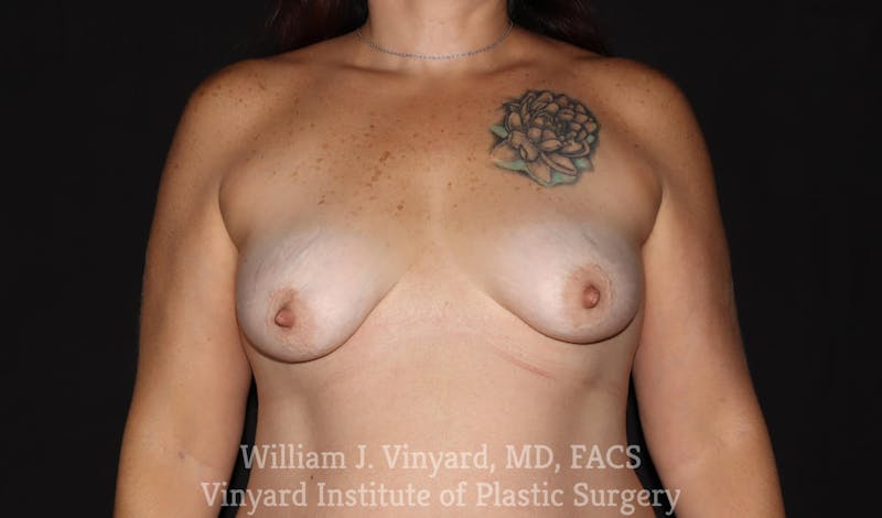 Breast Augmentation + Lift Before & After Gallery - Patient 171450622 - Image 1