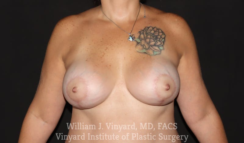 Breast Augmentation + Lift Before & After Gallery - Patient 171450622 - Image 2