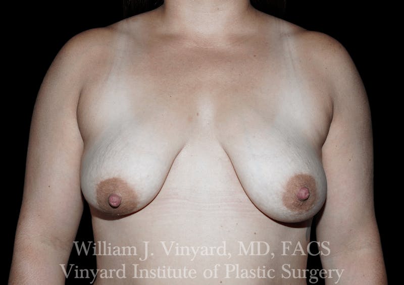 Breast Augmentation + Lift Before & After Gallery - Patient 171450624 - Image 1