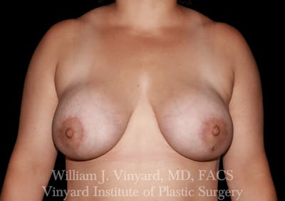 Breast Augmentation + Lift Before & After Gallery - Patient 171450624 - Image 2