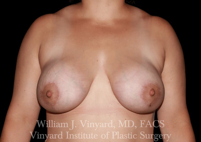 Breast Augmentation + Lift Before & After Gallery - Patient 171450624 - Image 2