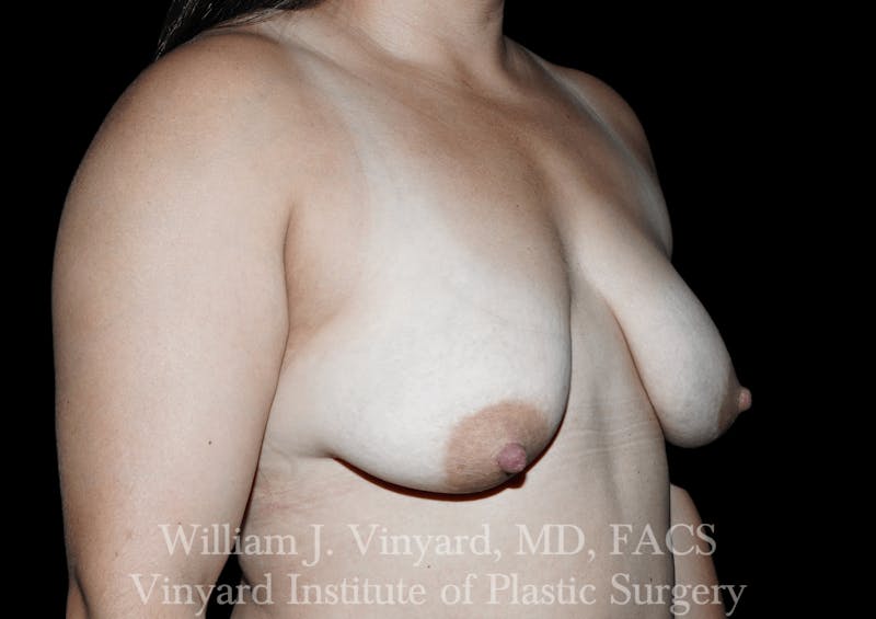 Breast Augmentation + Lift Before & After Gallery - Patient 171450624 - Image 3