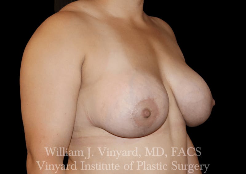Breast Augmentation + Lift Before & After Gallery - Patient 171450624 - Image 4