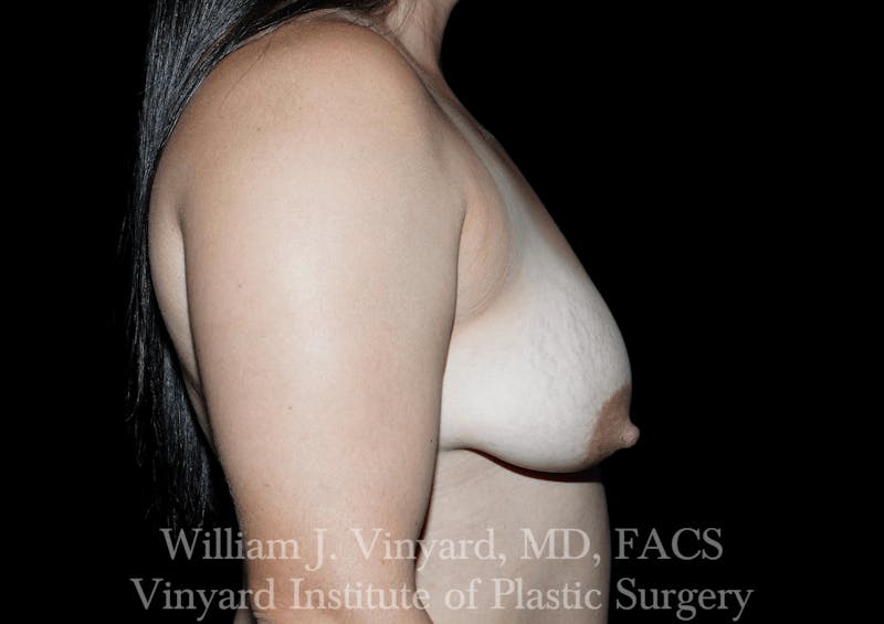 Breast Augmentation + Lift Before & After Gallery - Patient 171450624 - Image 5