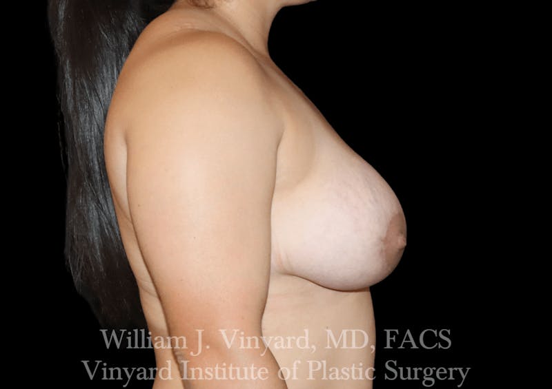 Breast Augmentation + Lift Before & After Gallery - Patient 171450624 - Image 6