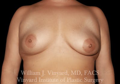Breast Augmentation + Lift Before & After Gallery - Patient 171450630 - Image 1