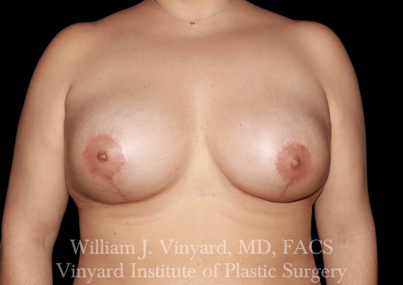 Breast Augmentation + Lift Before & After Gallery - Patient 171450630 - Image 2