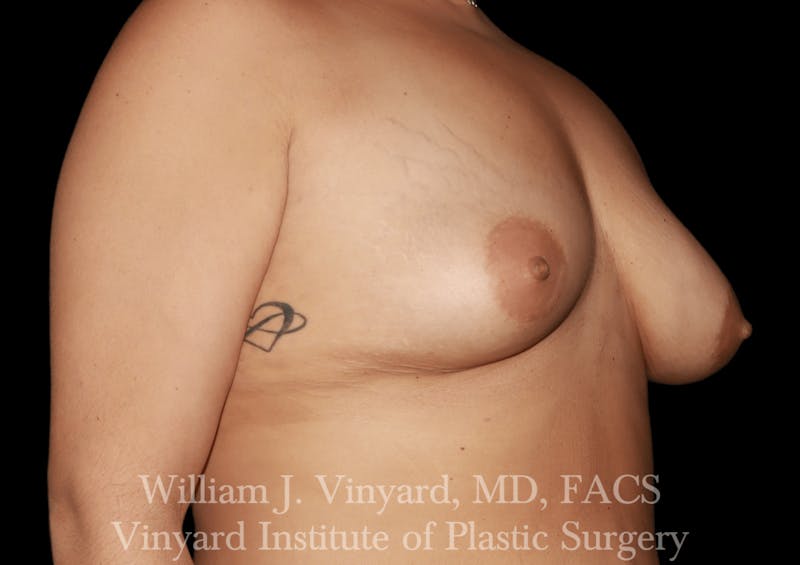Breast Augmentation + Lift Before & After Gallery - Patient 171450630 - Image 3