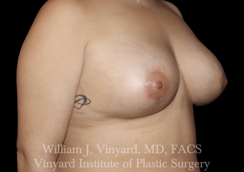 Breast Augmentation + Lift Before & After Gallery - Patient 171450630 - Image 4