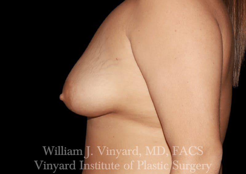 Breast Augmentation + Lift Before & After Gallery - Patient 171450630 - Image 5