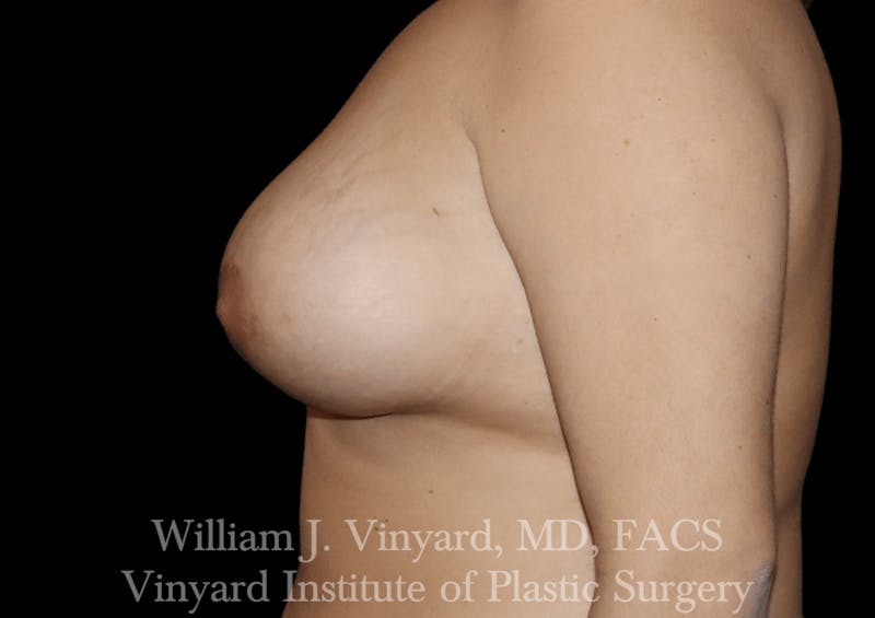 Breast Augmentation + Lift Before & After Gallery - Patient 171450630 - Image 6
