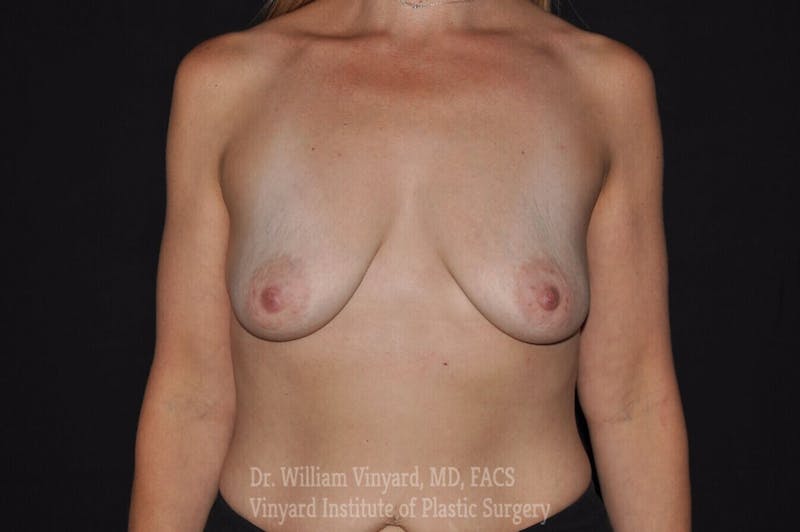 Breast Augmentation + Lift Before & After Gallery - Patient 171450637 - Image 1