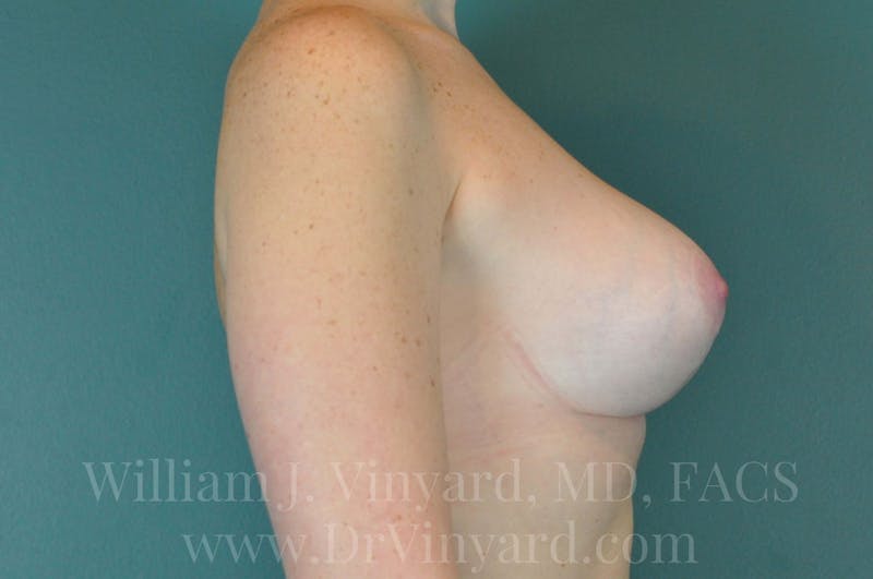 Breast Augmentation + Lift Before & After Gallery - Patient 171451740 - Image 2