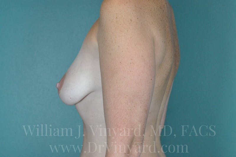Breast Augmentation + Lift Before & After Gallery - Patient 171451740 - Image 9