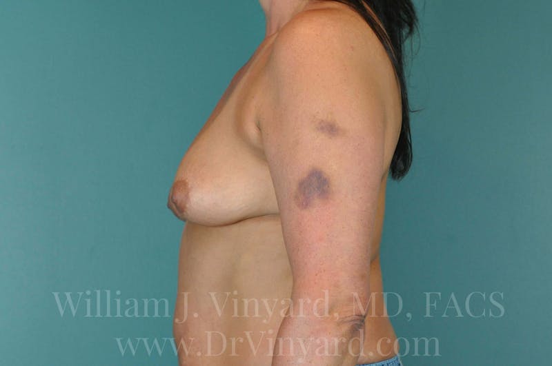 Breast Augmentation + Lift Before & After Gallery - Patient 171452159 - Image 9