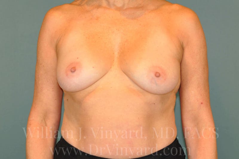 Breast Augmentation + Lift Before & After Gallery - Patient 171452797 - Image 5