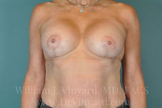 Breast Augmentation + Lift Before & After Gallery - Patient 171452797 - Image 6