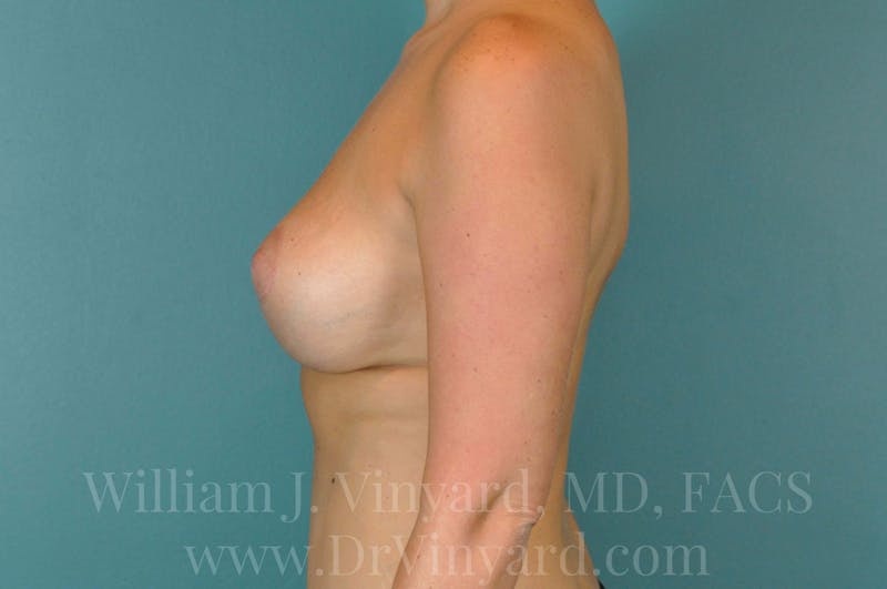 Breast Augmentation + Lift Before & After Gallery - Patient 171452839 - Image 10