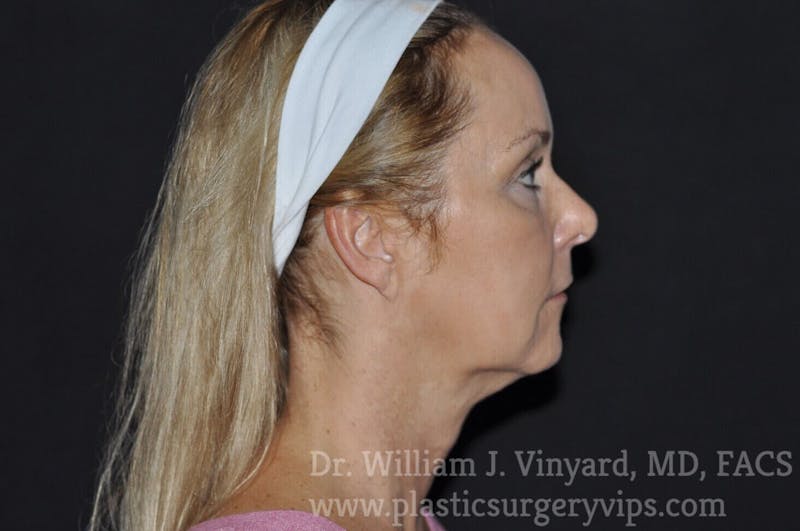 Facetite Before & After Gallery - Patient 171454968 - Image 1