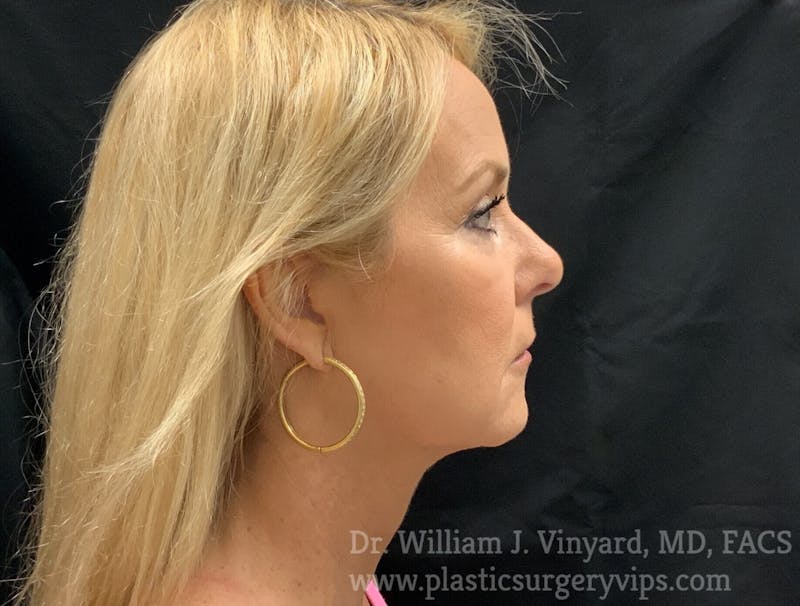 Facetite Before & After Gallery - Patient 171454968 - Image 2