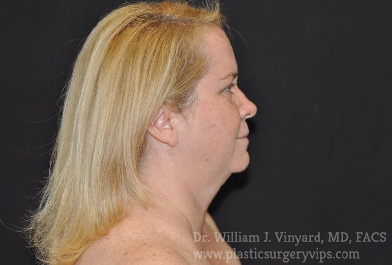 Facetite Before & After Gallery - Patient 171454977 - Image 1