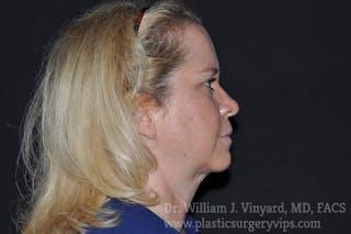 Facetite Before & After Gallery - Patient 171454977 - Image 2