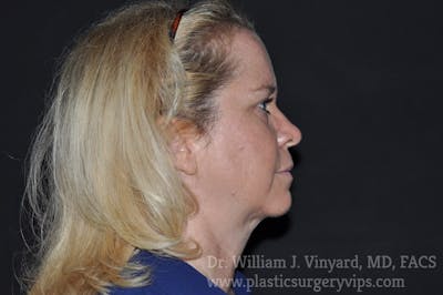 Facetite Before & After Gallery - Patient 171454977 - Image 2