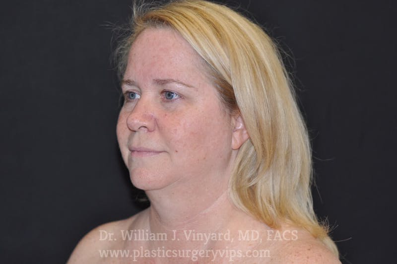 Facetite Before & After Gallery - Patient 171454977 - Image 3