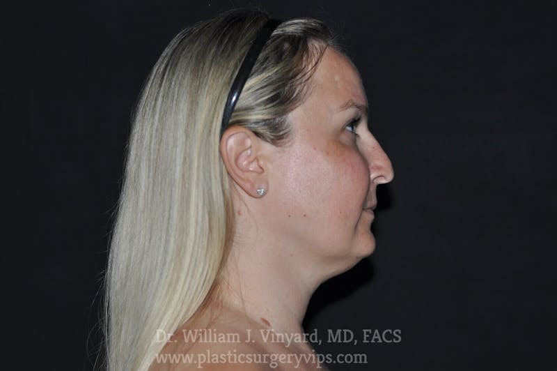 Facetite Before & After Gallery - Patient 171454988 - Image 1