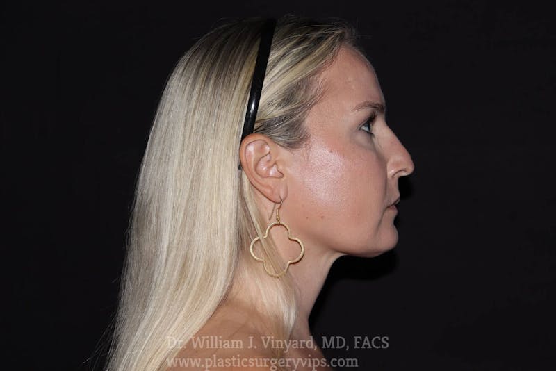 Facetite Before & After Gallery - Patient 171454988 - Image 2