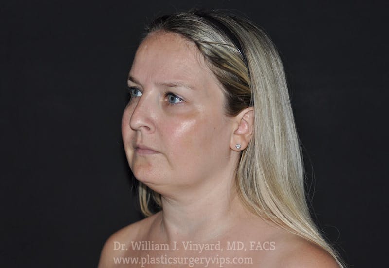 Facetite Before & After Gallery - Patient 171454988 - Image 3