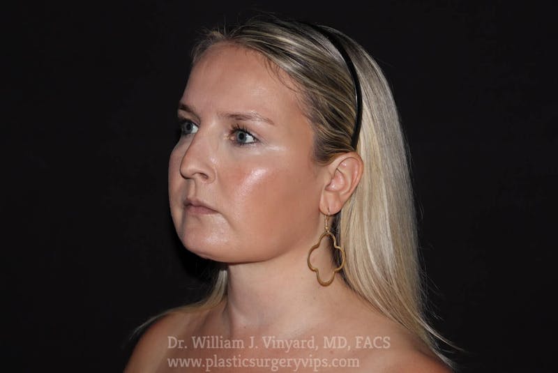 Facetite Before & After Gallery - Patient 171454988 - Image 4