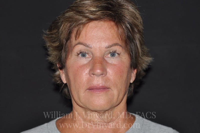 Facelift Before & After Gallery - Patient 169743456 - Image 1