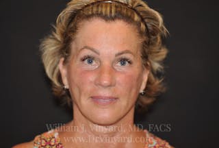 Facelift Before & After Gallery - Patient 169743456 - Image 2